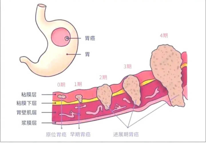 什么是慢性胃炎？